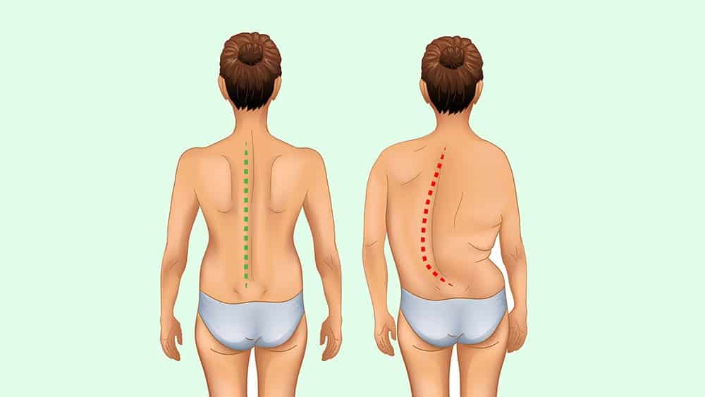 Escoliose degenerativa do adulto - Principais complicações - Dr